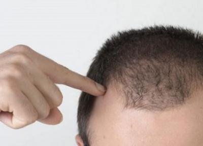 علت ریزش مو در مردان جوان چیست؟