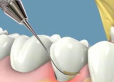 جرم گیری دندان چیست؟آیا جرم گیری به دندان آسیب می زند؟